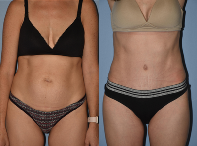 25-34 year old woman treated with Tummy Tuck - 25-34 year old woman treated with Tummy Tuck