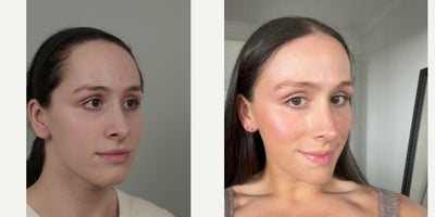 18-24 year old woman treated with AccuLift, Cheek Implants, Facial Fat Transfer, Forehead Reduction, Rhinoplasty, V Line Surgery - .