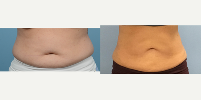 45-54 year old woman treated with Emsculpt - A series of 6 emsculpt sessions transformed this patient's abdomen and she is absolutely thrilled, noticing how much more toned and slim her midsection looks.
