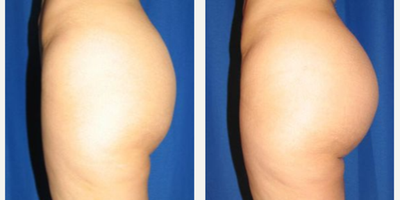 Woman treated with Butt Augmentation - Woman treated with Butt Augmentation