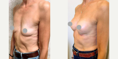 Woman treated with Breast Augmentation, Motiva Breast Implants, Breast Lift, Breast Implants - Breast Augmentation Ergonomix 2 E2SM 200cc Motiva Subfascial (1 Week)