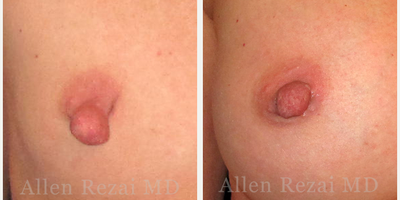 35-44 year old woman treated with Nipple Reduction - Pre- & 4 Weeks Post-op - Nipple Reduction SurgeryPhotos: Before & 4 Weeks After Surgery
