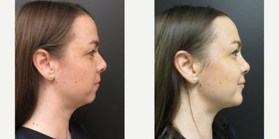 25-34 year old woman treated with Chin Implant, Rhinoplasty, Chin Liposuction - This patient underwent liposuction to her submental area, Rhinoplasty and Chin Implant