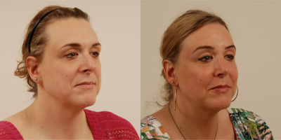 42 year old transgender woman underwent Facial Feminization Surgery. - This patient underwent a foreheadplasty with a frontal setback procedure with contouring of her frontal bone and shaping of her superior orbital rim. Note the decrease in the masculine appearing forehead before and after the setback. She also underwent nose refinement, cheek augmentation, and fat transfer to her tear troughs, nasolabial folds, upper and lower lips.