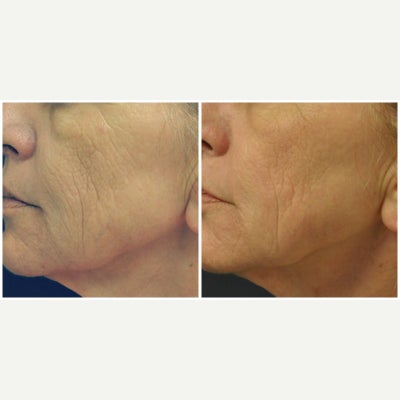 55-64 year old woman treated with Pixel Laser - This patient wanted the deep lines on her cheeks softened without having to undergo surgery.