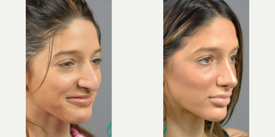 Woman treated with Rhinoplasty, Septoplasty - Upon examination, Dr. Marotta determined that she required septoplasty, turbinate reduction, and repair of nasovestibular stenosis to open up her airway and improve her breathing. It was discussed that at the same time he would perform a cosmetic rhinoplasty to make the esthetic improvements she desired. It is very common for patients to elect to have cosmetic changes made at the time of a medically necessary procedure as it allows for one recovery and delivers the most comprehensive results.