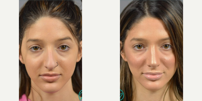 Woman treated with Rhinoplasty, Septoplasty - Upon examination, Dr. Marotta determined that she required septoplasty, turbinate reduction, and repair of nasovestibular stenosis to open up her airway and improve her breathing. It was discussed that at the same time he would perform a cosmetic rhinoplasty to make the esthetic improvements she desired. It is very common for patients to elect to have cosmetic changes made at the time of a medically necessary procedure as it allows for one recovery and delivers the most comprehensive results.