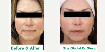 55-64 year old woman treated with Glacial Rx - Post 2 Glacial Rx Gloss treatmentsGenerally clearer, less red and smoother appearing skin after only 2 treatments.