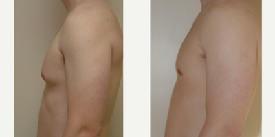25-34 year old man treated with Breast Implant Revision - liposcution