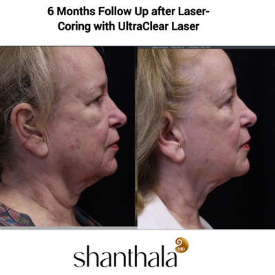 Laser-Coring with UltraClear Laser 74 years Old Full Face & Neck - Laser-Coring with UltraClear Laser with Dr. Shanthala - 74 years old patient who never received any aesthetic treatments other than UltraClear Laser Coring was thrilled with her total skin rejuvenation, significant improvement in dyspigmentation, skin tightening especially in the neck & jawline.