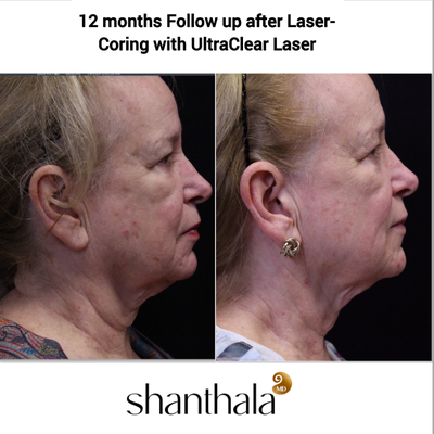 Laser-Coring with UltraClear Laser 74 years Old Full Face & Neck - Laser-Coring with UltraClear Laser with Dr. Shanthala - 74 years old patient who never received any aesthetic treatments other than UltraClear Laser Coring was thrilled with her total skin rejuvenation, significant improvement in dyspigmentation, skin tightening especially in the neck & jawline.
