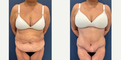45-54 year old woman treated with Tummy Tuck, Liposuction, Power-Assisted Liposuction (PAL) - This beautiful weight loss patient underwent Tummy tuck with Liposuction to create a flatter and more defined abdominal contour.  The swelling will continue to improve over time.