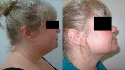 35-44 year old woman treated with PrecisionTx - Smartlipo of chin/neck with Precision Tx.