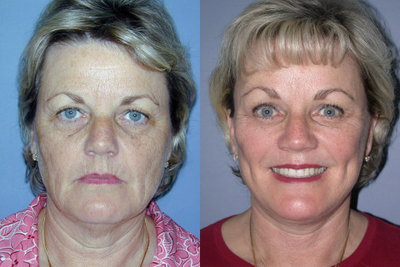 This 56-year-old Woman had a Face Lift, Blepharoplasty, and a Brow Lift - This 56-year-old Woman had a Face Lift, Blepharoplasty, and a Brow Lift.