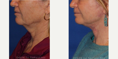 55-64 year old woman treated with Facelift, Chin Liposuction, CO2 Laser, Lip Lift - This patient had a facelift, submental liposuction, eCO2 laser to her bilateral periorbital areas and SMAS to her upper and lower lips.