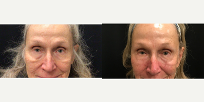 69 year old woman treated with Agnes RF to under eyes by Dr. Ritacca - 69 year old woman treated with Agnes RF to under eyes by Dr. Ritacca