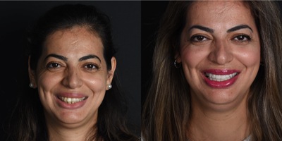 35-44 year old woman treated with Smile Makeover, Porcelain Veneers, Dental Bridge - Our patient had ill fitting old bridges and poor esthetic. We made her a digital smile design and delivered zirconia crowns on teeth to achieve an ideal esthetic result.