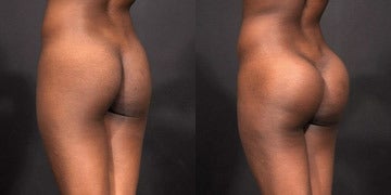 Butt Implants Before and After Photos