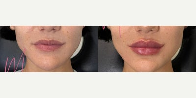 35-44 year old woman treated with Lip Fillers, Botox for Gummy Smile, Botox - Treated by Aubrey Houchin - Lip flip and lip filler for symmetry