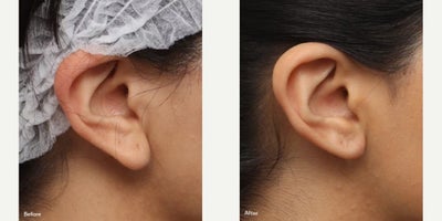 Woman treated with Earlobe Repair - Case Details2 Month Earlobe Repair