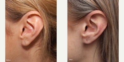Woman treated with Earlobe Repair - Case Details6 Year Earlobe Repair