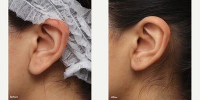 Woman treated with Earlobe Repair - Case Details2 Month Earlobe Repair