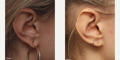 Woman treated with Earlobe Repair - Case Details11 Months Earlobe Repair