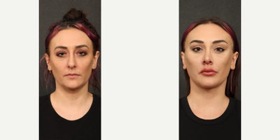 25-34 year old woman treated with Facial, Neck Lift - 25-34 year old woman treated with Facial, Neck Lift