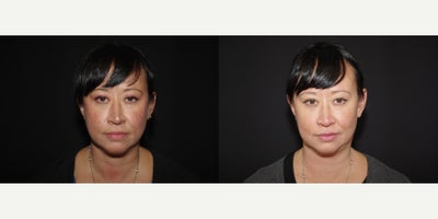 35-44 year old woman treated with Bellafill - 41 year old female received 2 syringes of Bellafill to the Lips & Cheeks; photos depict the patient's results 4 months post-op.