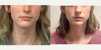18-24 year old woman treated with Adam's Apple Reduction, Genioplasty, Facial Feminization Surgery - This lady underwent an adam's apple reduction and mandible/chin feminization.