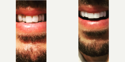 Man treated with Dental Bonding - Man treated with Dental Bonding