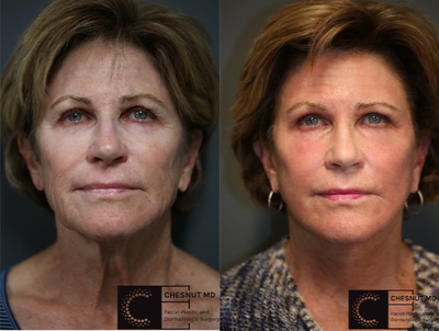 Fractora RF - Fractora RF