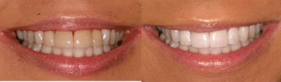 Whitening - 
	zoom teeth whitening.
