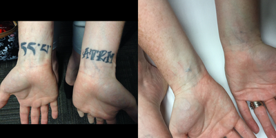 25-34 year old woman treated with Enlighten - Patient's tattoos are considerably lighter after 5 enlighten laser tattoo removal treatments.