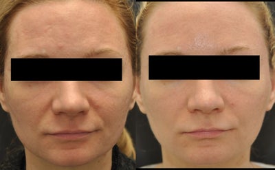 Facial Aging Grooves - 
	This patient received two treatments of liquid injectable silicone to improve her facial aging grooves.
