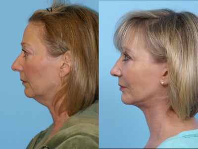 Facelift, Rhinoplasty, Eyelid Lift, Chin Implant, Endoscopic Browlift - 
	This patient had a facelift, browlift, Upper eyelid lift, Rhinoplasty and Chin Implant. She is a great example of how putting together multiple surgeries can create a harmonious look.
