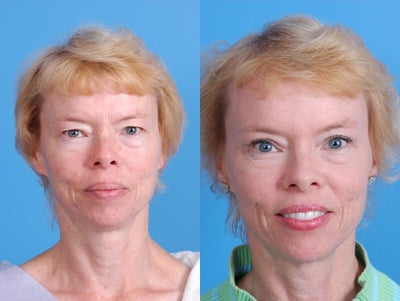 50 year old female treated for fullness of the upper lids - 
	Patient underwent endoscopic browlift and upper lid blepharoplasty to refresh her upper face and give her a youthful but natural look
