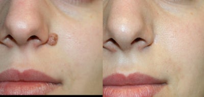 Mole Removal - 
	Mole Removal
