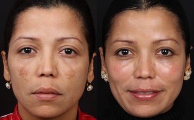Cosmelan for Melasma - Patient was treated with Cosmelan MD (Hydroquinone) for melasma.&nbsp;