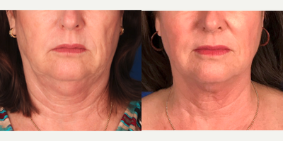 55-64 year old woman treated with Profound RF - One Profound Rf treatment, supplemented with one Excel V treatment for post-op bruising and 2 Sublative RF treatments to smooth fine lines and wrinkles.