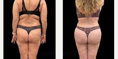 45-54 year old woman treated with Liposuction - Liposuction, Fat Grafting #001Remedy: Liposuction of the back, waist, and thigh with fat grafting to her buttocksPost-Op: 4 weeks
