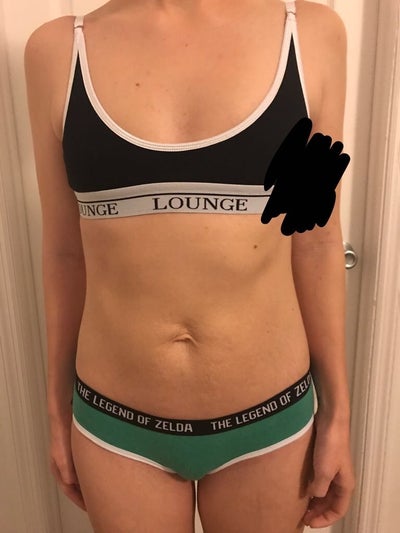 32A to 32D after Sientra 300cc's. 5'1, 105 lbs. - Review - RealSelf
