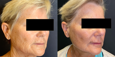 65-74 year old woman treated with Potenza - Results with full face Potenza RF-Microneedling