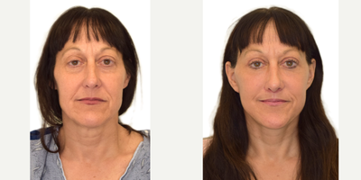 55-64 year old woman treated with Deep Plane Facelift, Brow Lift, Facial Fat Transfer, Eyelid Surgery, Lip Lift, Ellacor - 1. Extended deep-plane facelift2. Temporal brow lift3. Fat grafting to tear troughs and nasolabial folds4. Upper blepharoplasty5. Lip lift6. Ellacor to the forehead and perioral region
