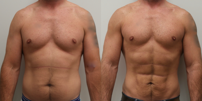 35-44 year old man treated with Abdominal Etching - 35-44 year old man treated with Abdominal Etching