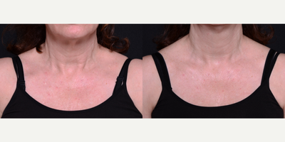 Woman treated with Microneedling - Woman treated with Microneedling