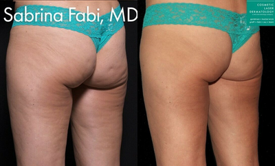 Woman treated with Qwo - Qwo injections to treat cellulite on the buttocks by Dr. Fabi