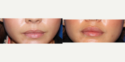 25-34 year old woman treated with Restylane - 32 year old female wanted fuller but natural lips. I used Restylane filler on her. Here she is 2 weeks after injecting.