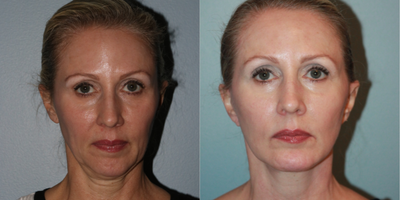 50 year old woman treated with Lifestyle Lift - This 50 year old patient wanted to combat the early signs of facial aging. The doctor performed his exclusive LiteLift modified facelift with a platysmaplasty and chin augmentation. Her jaw and neckline look natural, refreshed and more youthful after surgery. The chin augmentation helped improve contour and facial proportion.