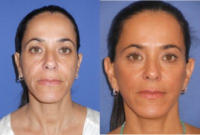 45-54 year old woman treated with Eyelid Surgery - Bilateral Upper Blepharoplasty andFace/Neck lift with SMAS flaps and fat grafting